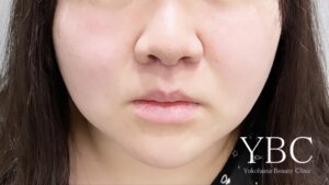 人中短縮術後