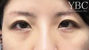 眉下リフト・眉下切開術後