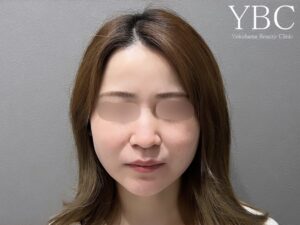 Vライン3D脂肪吸引バッカルファット YBC式小顔リフト術後