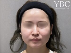 Vライン3D脂肪吸引バッカルファット YBC式小顔リフト術前