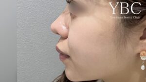 YBC式鼻先シャープ術鼻尖形成術後