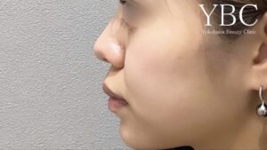 YBC式鼻先シャープ術鼻尖形成術前