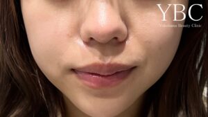 YBC式鼻翼縮小鼻尖形成YBC式鼻先シャープ術術後