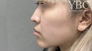 耳介軟骨移植術前