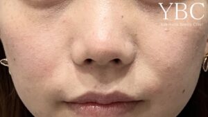 鼻尖形成、YBC式鼻先シャープ術術後