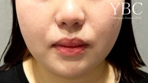 1dayVライン3D脂肪吸引・YBC式小顔リフト術後