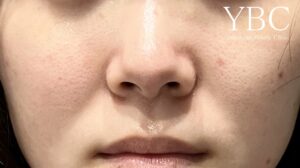 鼻尖形成YBC式鼻先シャーププロテーゼ