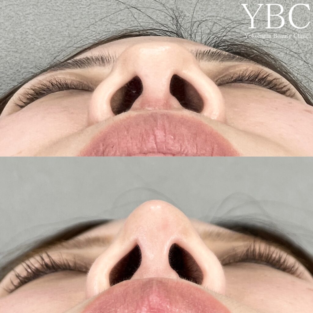 鼻尖形成・YBC式鼻先シャープ術
