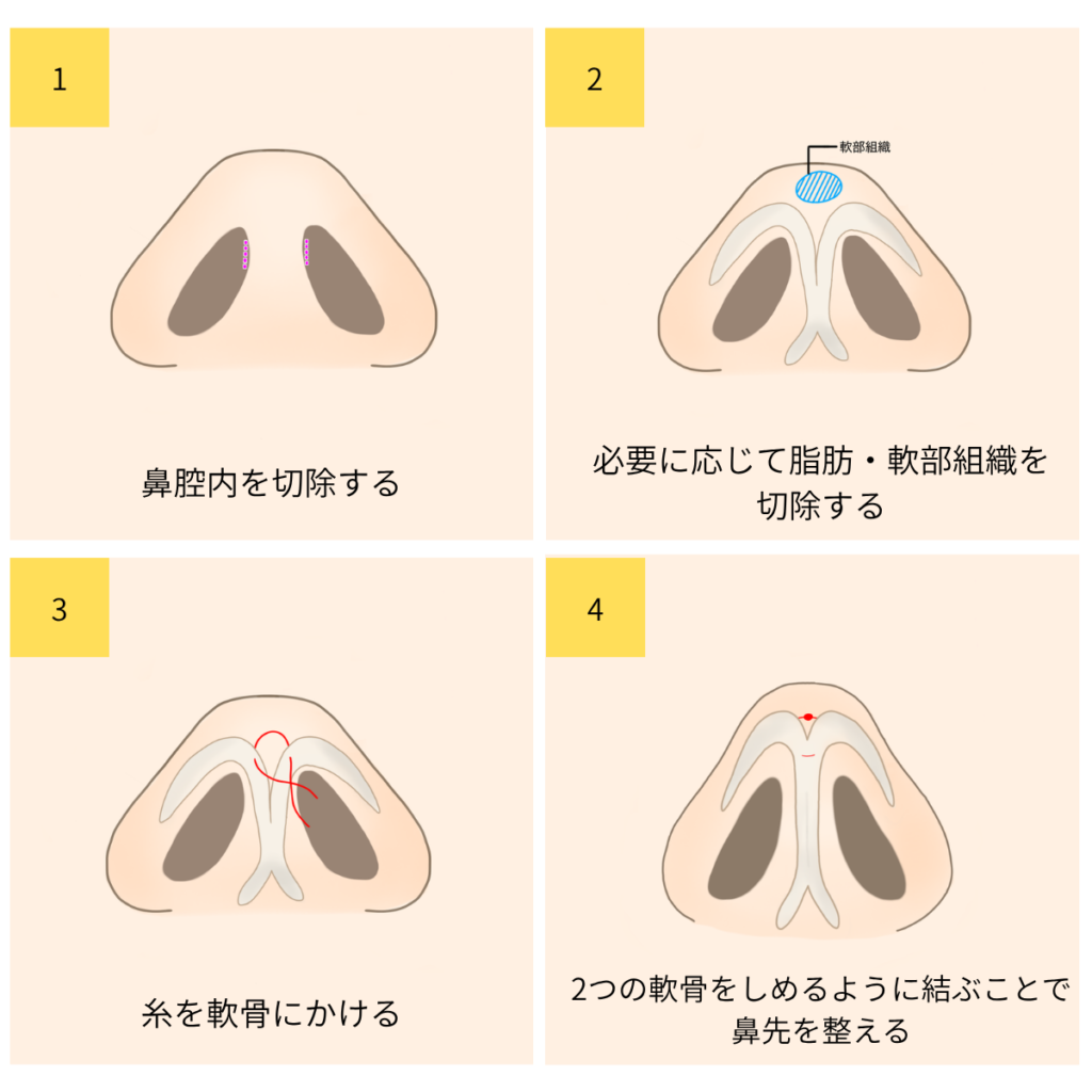 YBC式鼻尖形成施術方法
