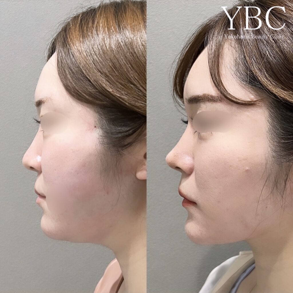 YBC式鼻尖形成・YBC式鼻先シャープ術・1dayVライン3D脂肪吸引・YBC式小顔リフト