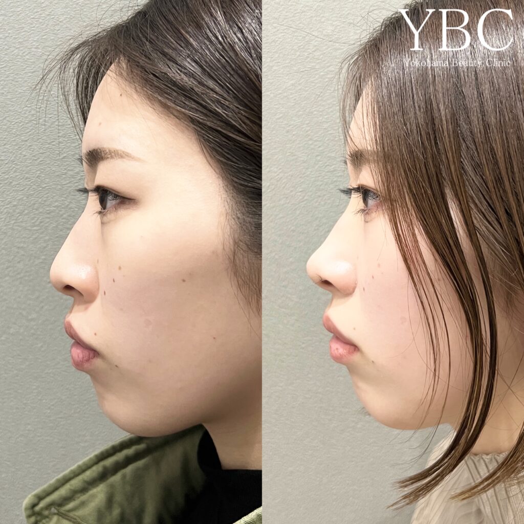 YBC式鼻尖形成・YBC式鼻先シャープ術