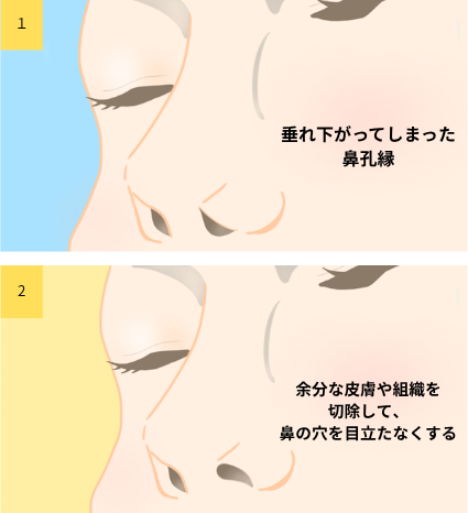 鼻孔縁挙上