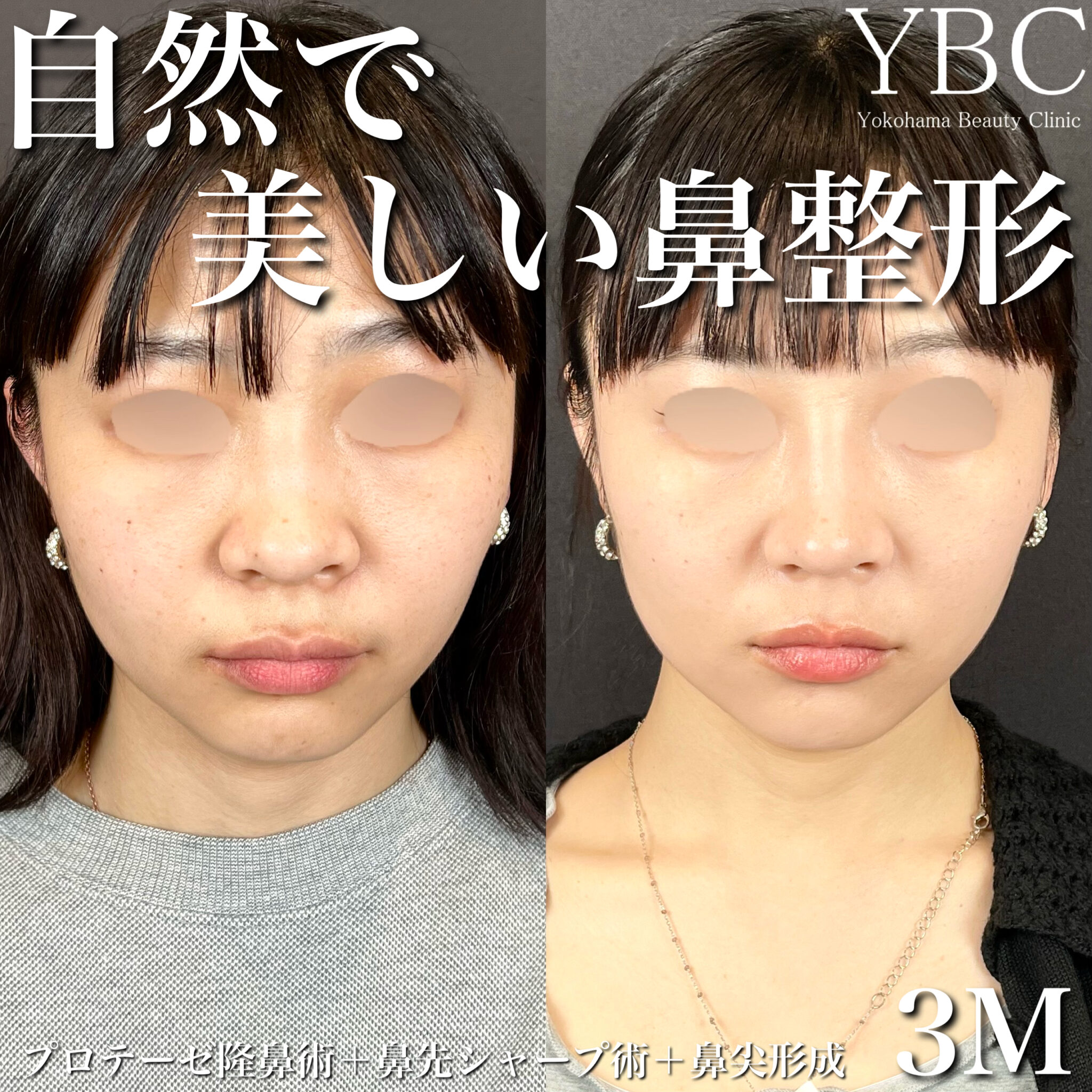 【鼻整形】プロテーゼ隆鼻術・鼻先シャープ術・鼻尖形成 3M | YBC横浜美容外科