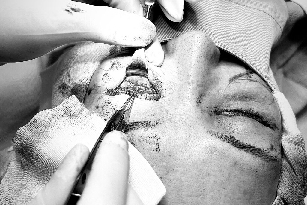 脂肪注入後のしこり・石灰化の除去