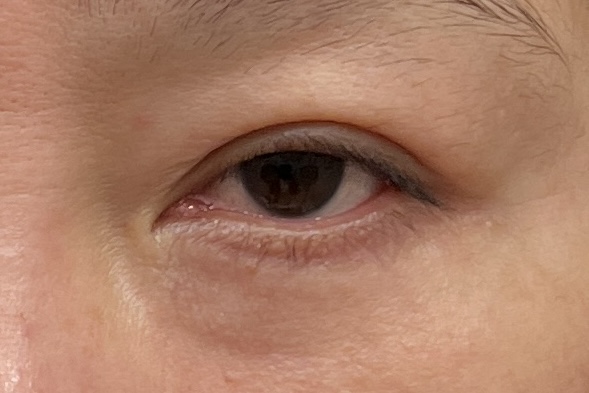 表ハムラ法による目の下の傷跡