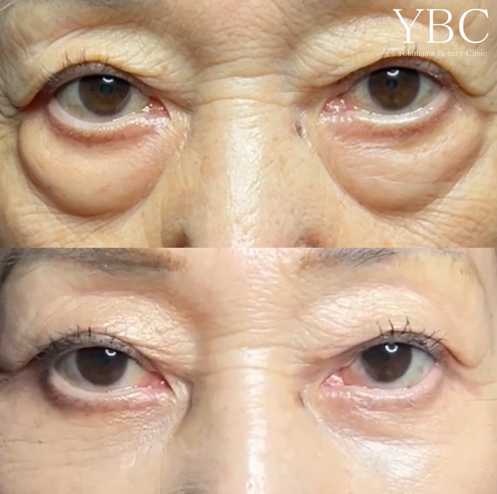 経結膜脱脂＋ヒアルロン酸、７０代女性