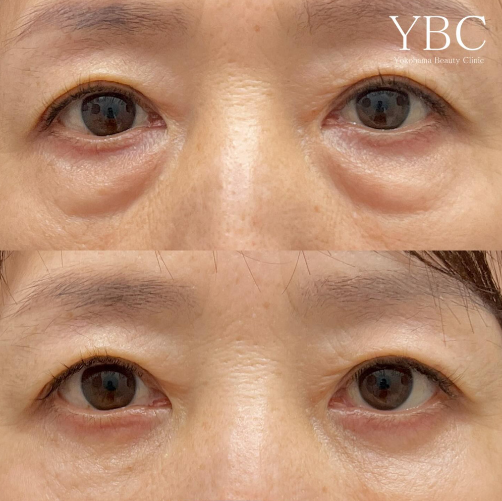 経結膜脱脂＋ヒアルロン酸２