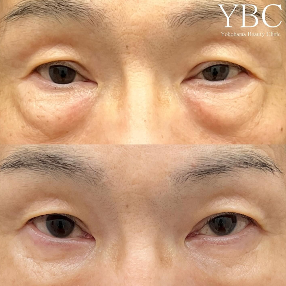 経結膜脱脂＋ヒアルロン酸、男性