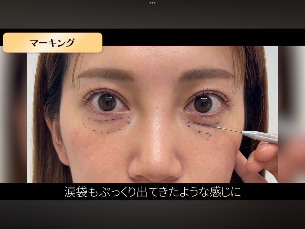 経結膜脱脂シミュレーション