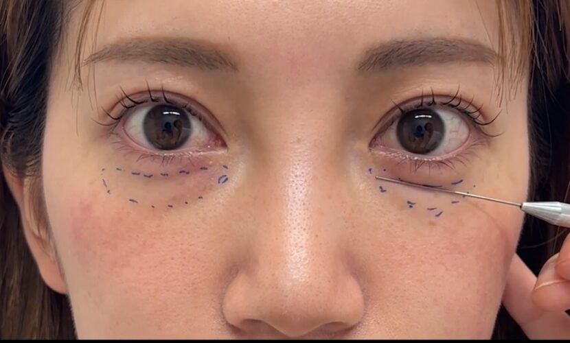 経結膜脱脂シミュレーション