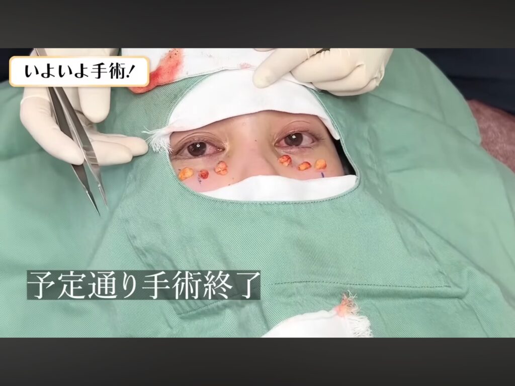 経結膜脱脂手術中