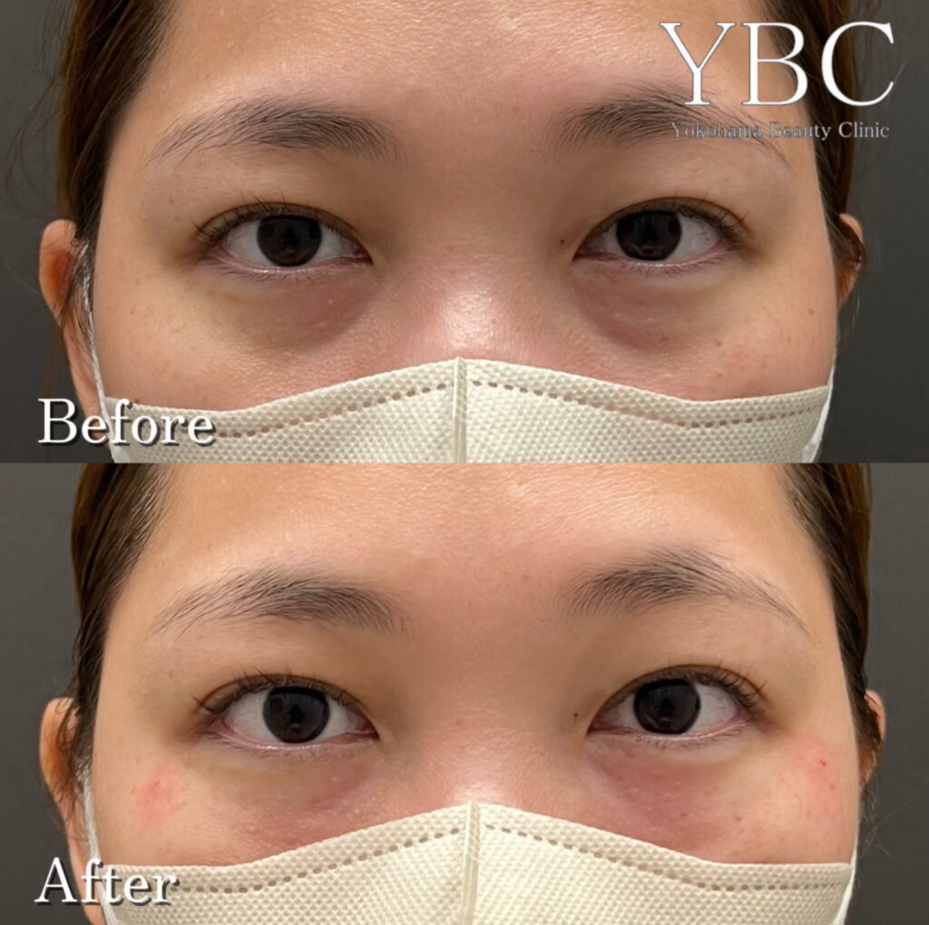 ヒアルロン酸でのクマ治療