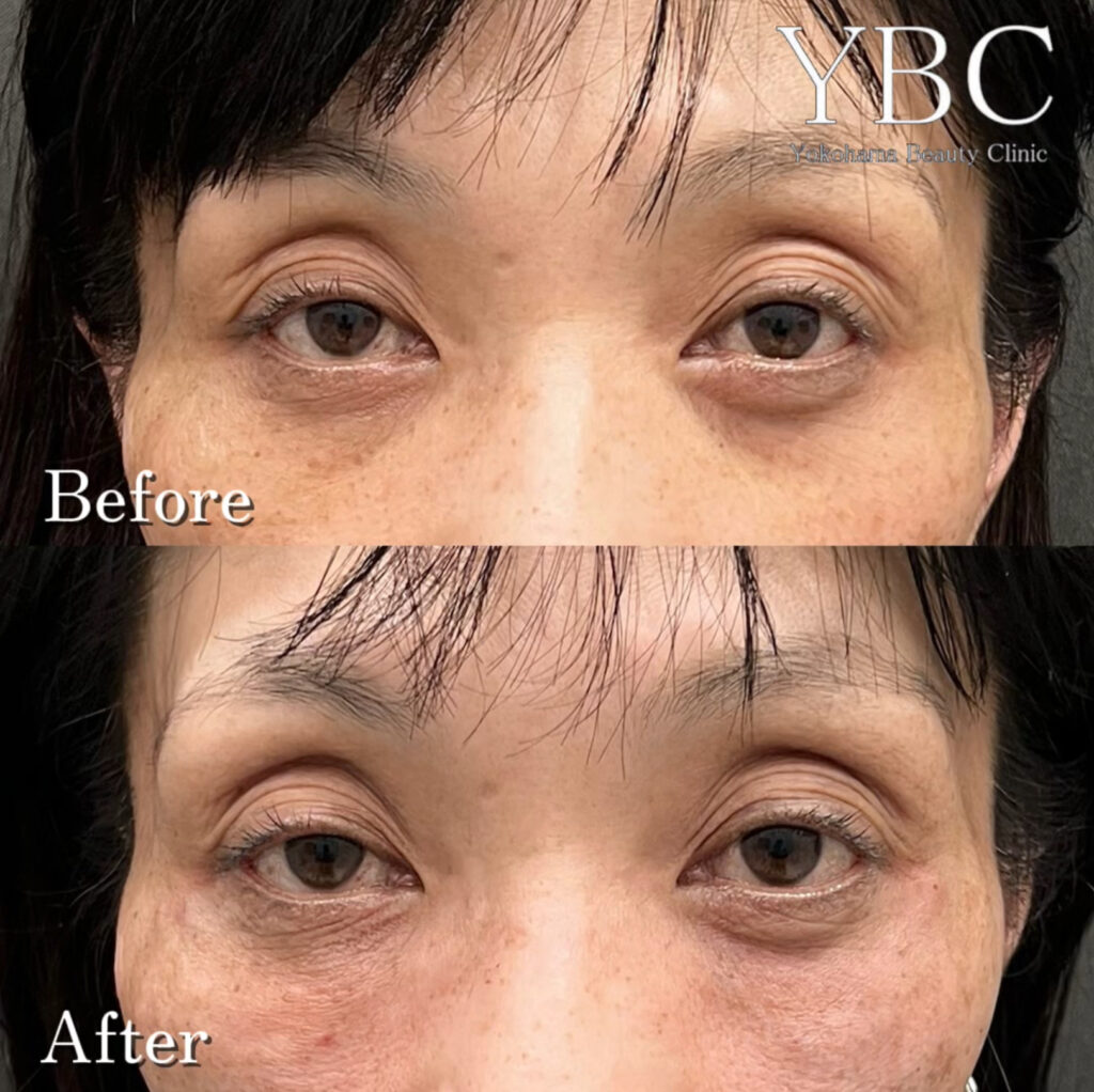 ヒアルロン酸でのクマ治療