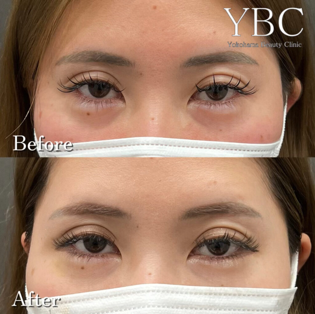 ヒアルロン酸でのクマ治療