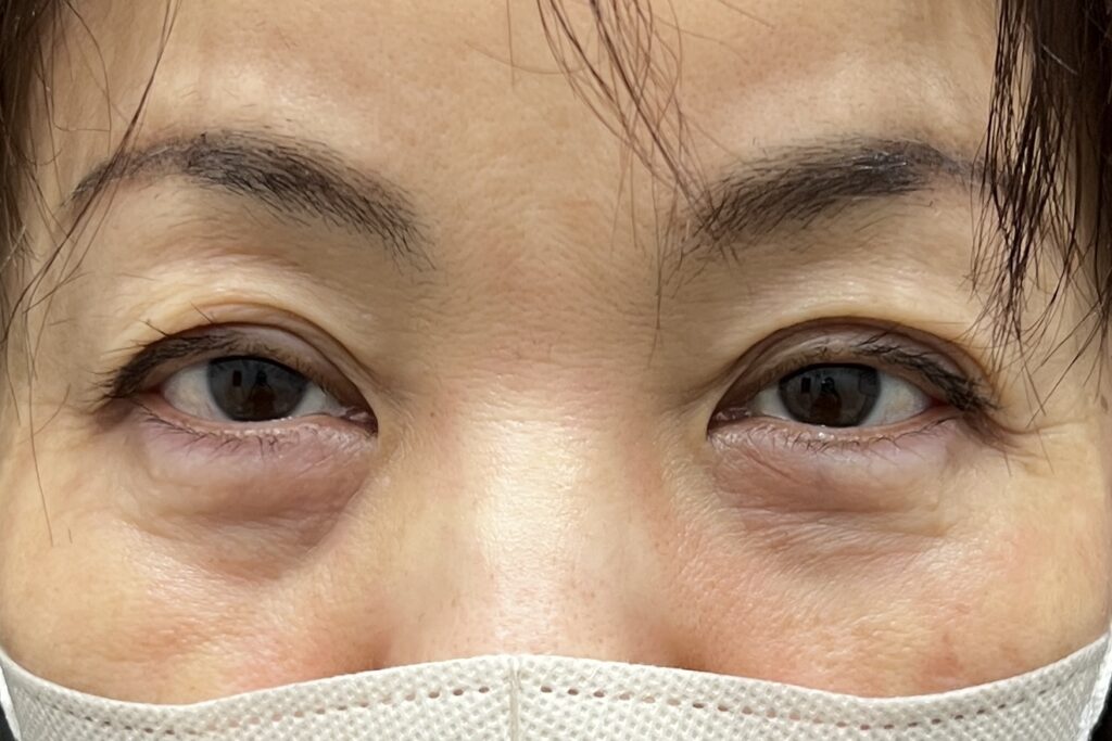 重度の皮膚のたるみ