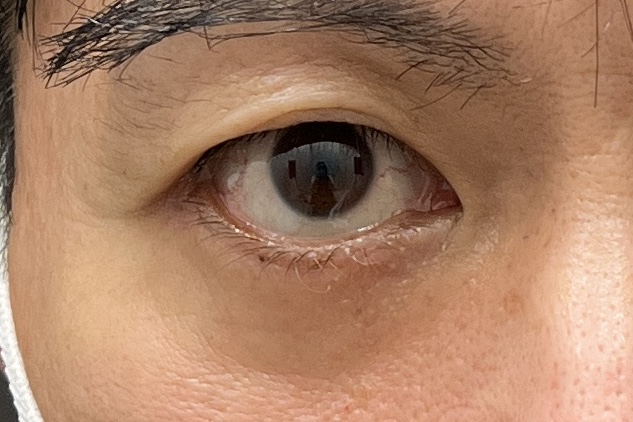 脱脂による凹み