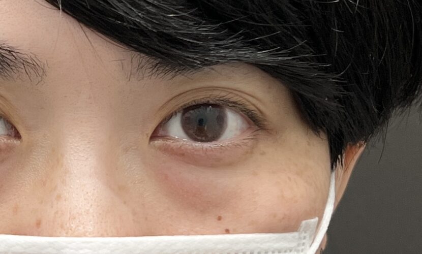 赤クマの原因と治療法