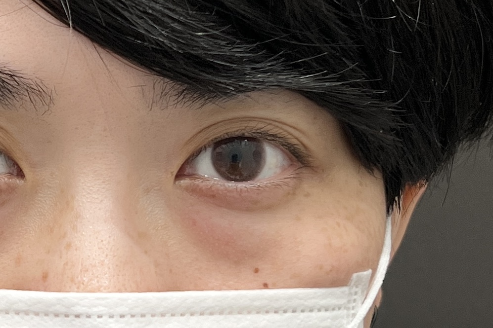 赤クマの原因と治療法