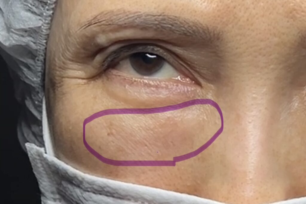 脂肪注入によるしこり