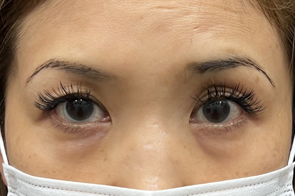 中等度以上の黒クマ