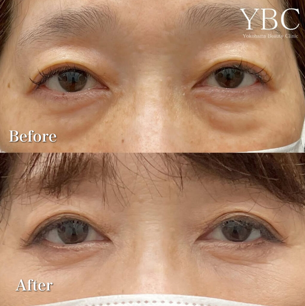 茶クマ症例写真2