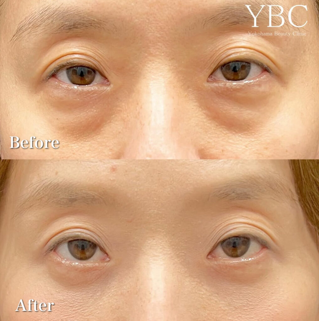 茶クマ症例写真3