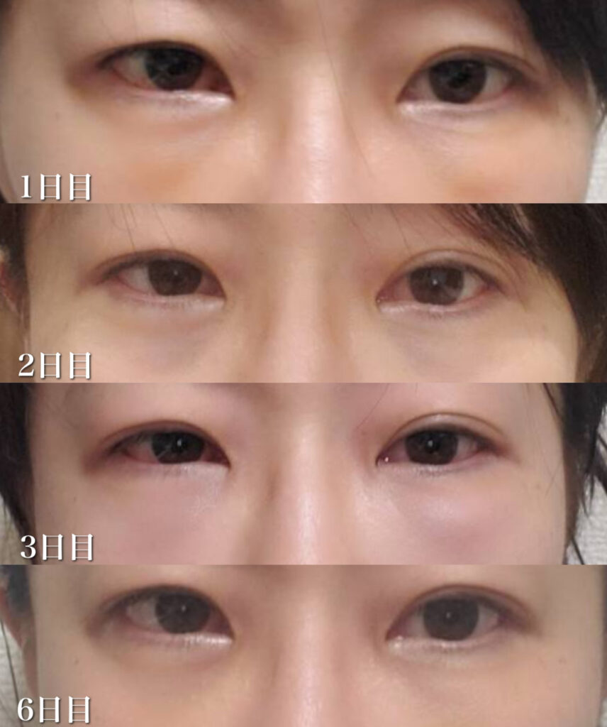 クマ取り治療ダウンタイムの経過