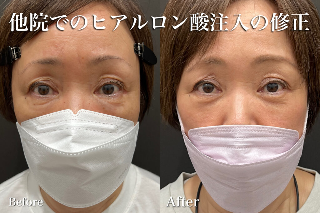 ヒアルロン酸注入の他院修正