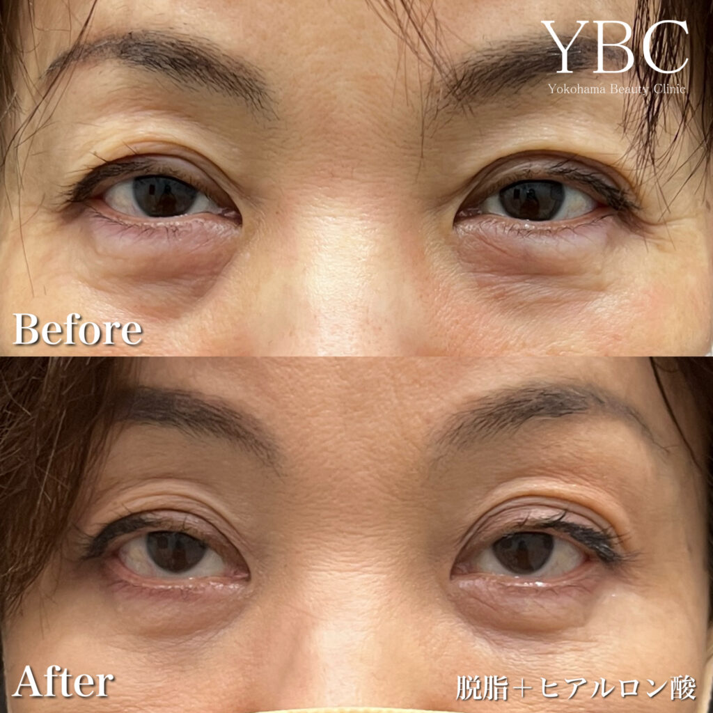 重度の皮膚のたるみ