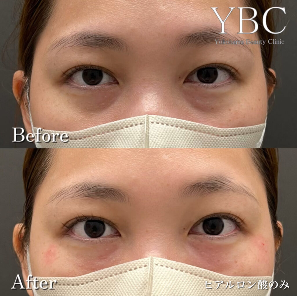 黒クマをヒアルロン酸で治療