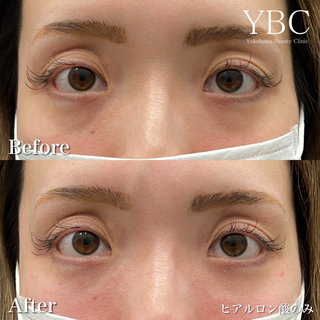 ヒアルロン酸でのクマ治療