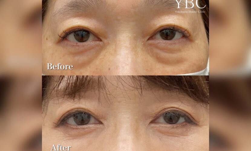 茶クマの原因と治療法