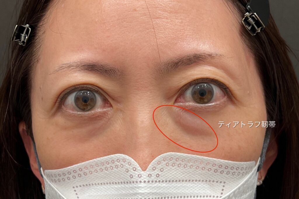 ティアトラフ靭帯