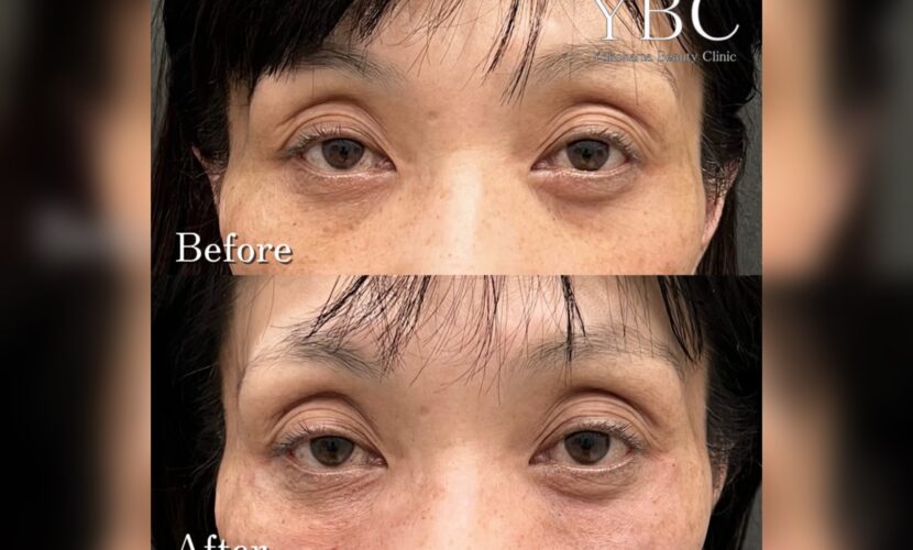 ヒアルロン酸注入