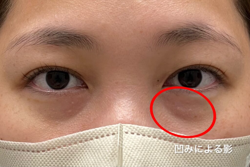 凹みによる黒クマ