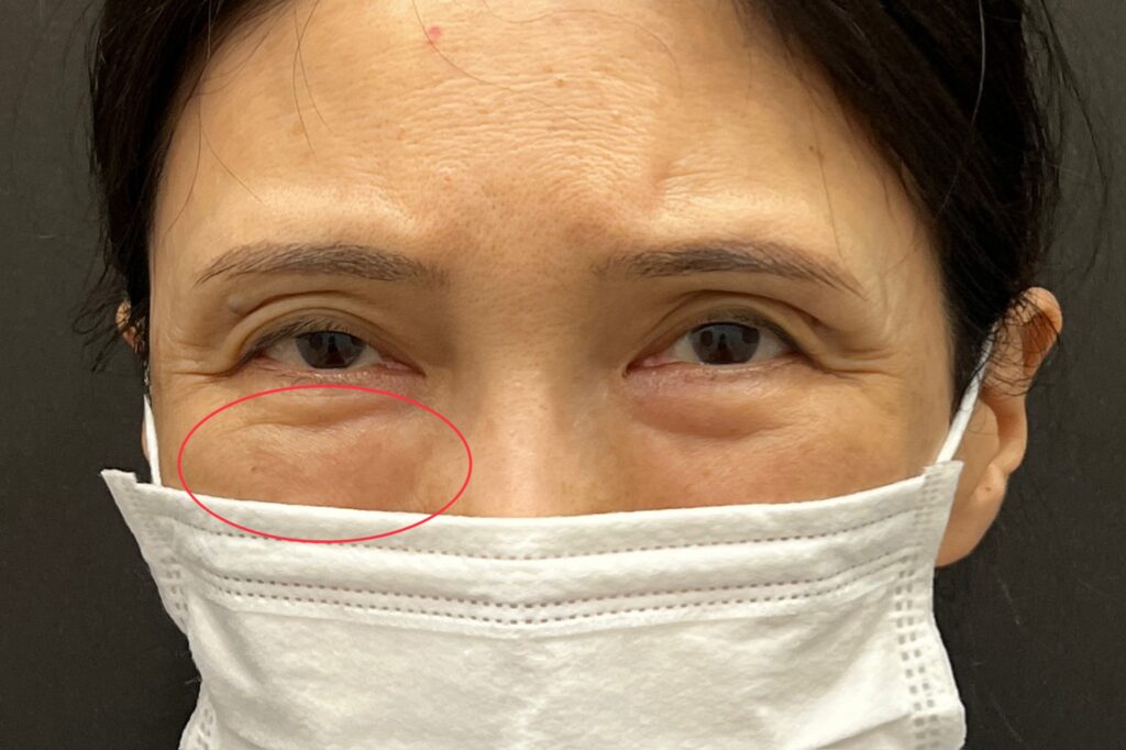 脂肪注入とヒアルロン酸の比較