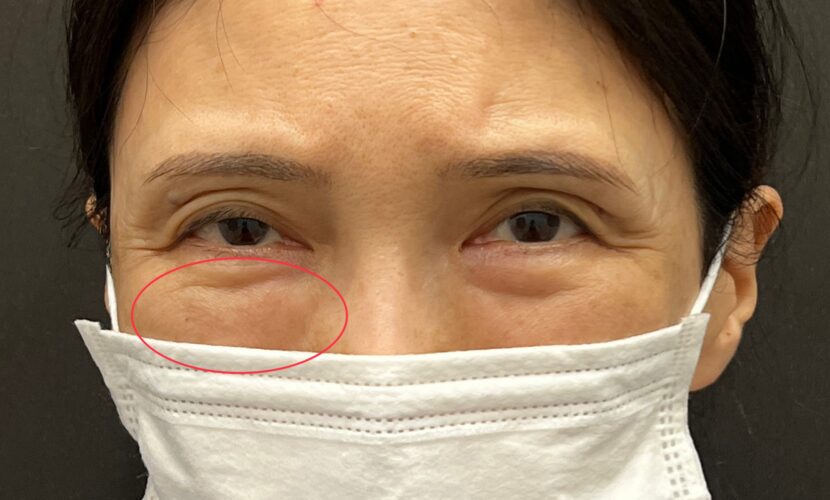 脂肪注入とヒアルロン酸の比較