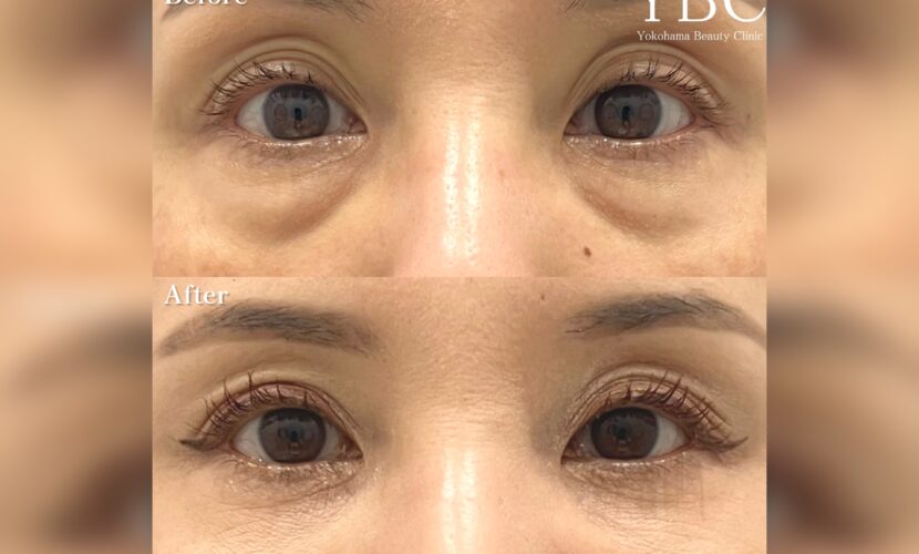 黒クマの症例写真