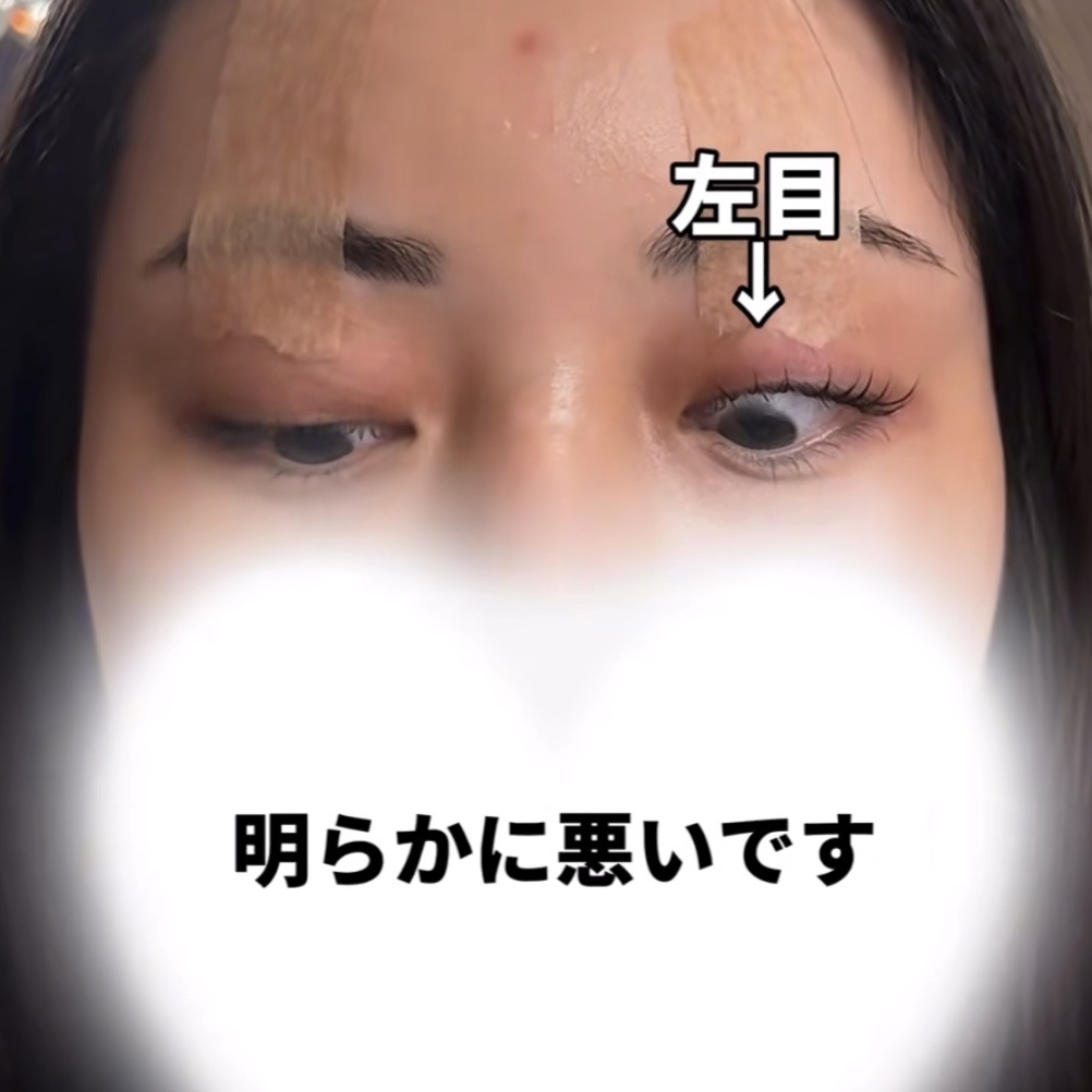 裏ハムラ法後の複視