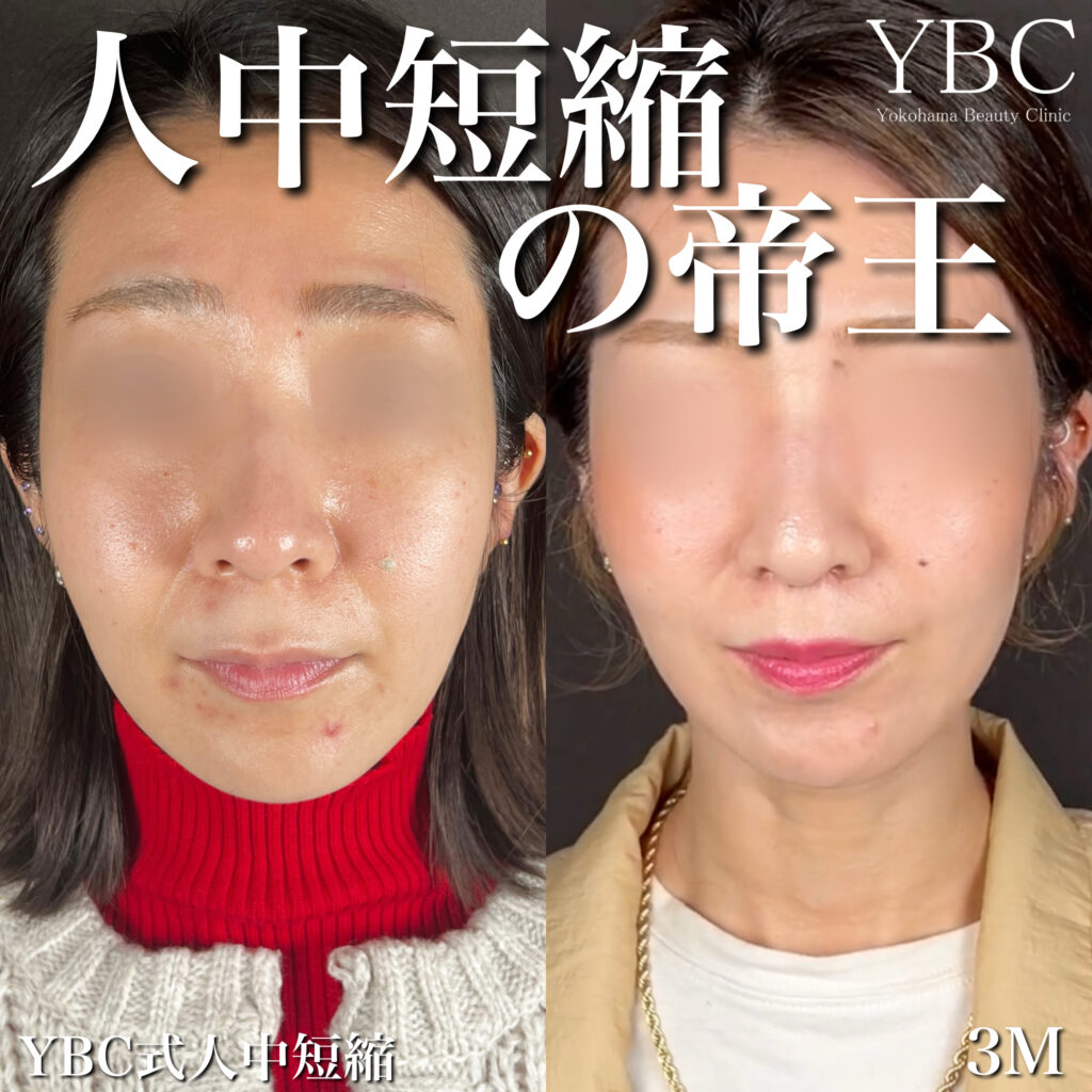 人中短縮症例写真